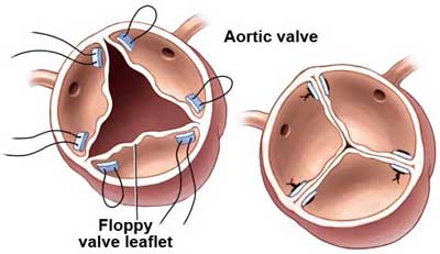 Aortic Valve Repair Diagram for Aortic Regurgitation