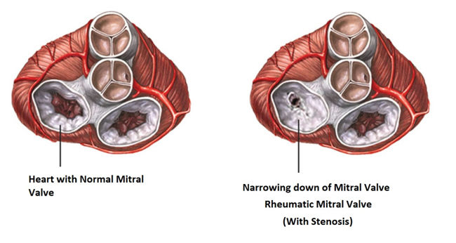 rheumatic endocarditis)