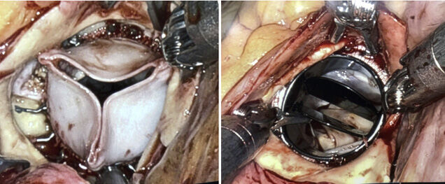 Robot Implanted Aortic Valve Replacement - Tissue &amp; Mechanical