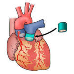 northwestern-medicine-100-ross-procedure