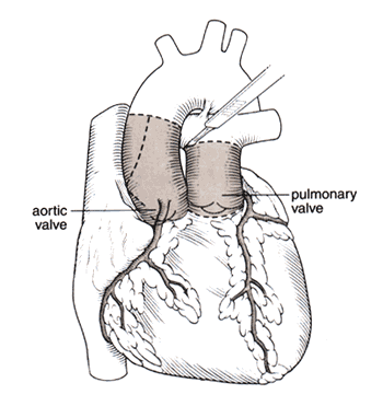 Ross Procedure Complications