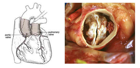 The Ross Procedure & Bicuspid Valve