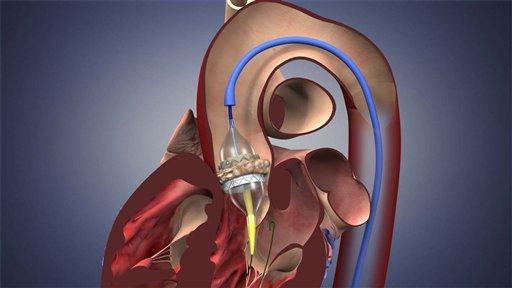 Medical Image Of TAVI Positioned Via Transfemoral