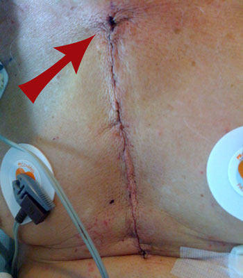 Top Incision Bump After Heart Surgery - Patient Picture