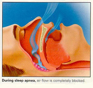 Sleep Apnea Heart Strain On Patients With Aortic Valve Stenosis