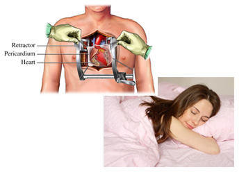 Sleep After Open Heart Valve Surgery On Your Stomach (Tummy)