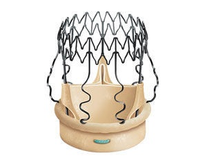 Perceval Aortic Heart Valve Replacement