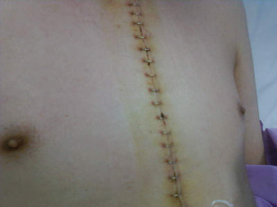 Stapled Incision Closure for Heart Surgery Patient