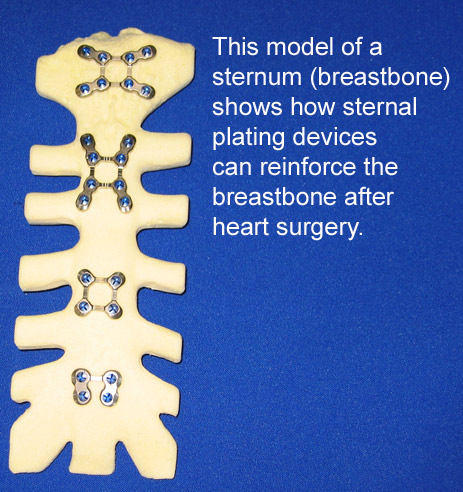 Sternal Plating After Median Sternotomy Heart Surgery