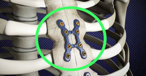 Rigid Sternal Fixation Diagram