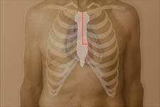 Does Your Chest Hurt After Heart Surgery?