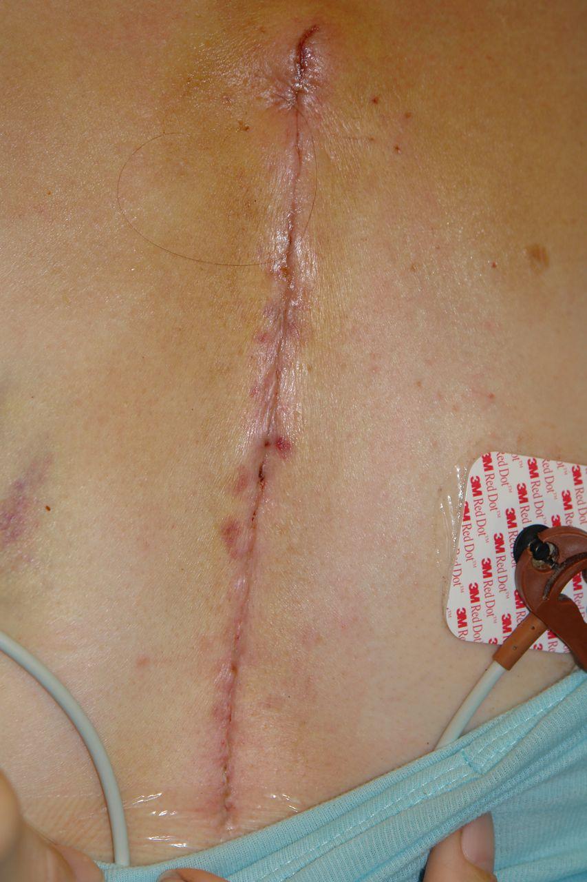 Female Sternum Incision Scar