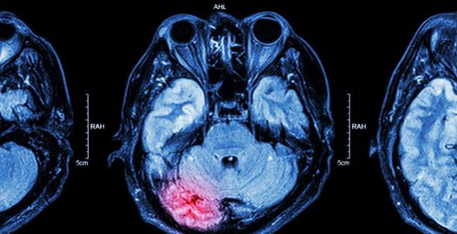 Brain scan of stroke after TAVR