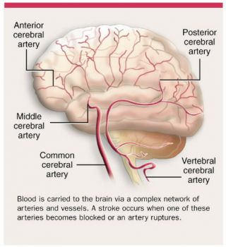 Stroke Risk Associated With Cardiac Surgery