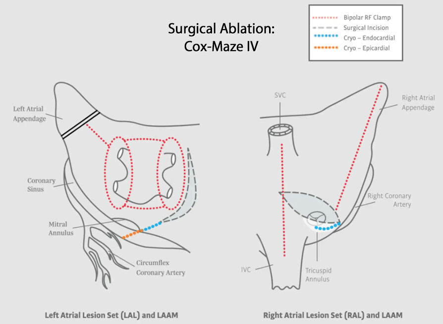 Cox-Maze IV Surgical Ablation Diagram