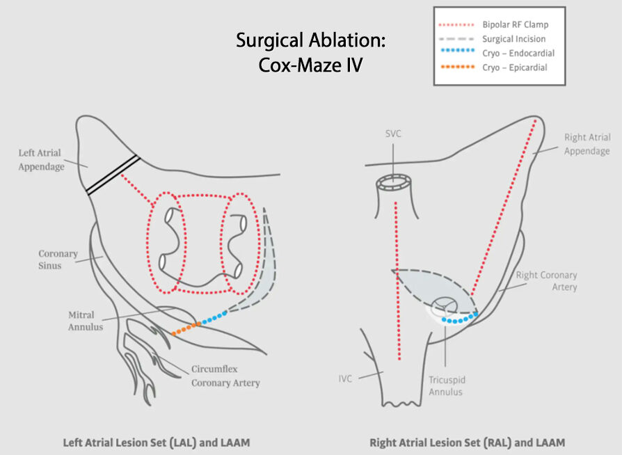 Cox-Maze IV Surgical Ablation Diagram