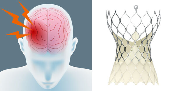 Stroke Risk, TAVR & Cerebral Protection