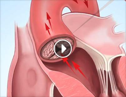 About Aortic Stenosis