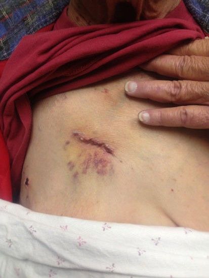 Transaortic TAVR Incision