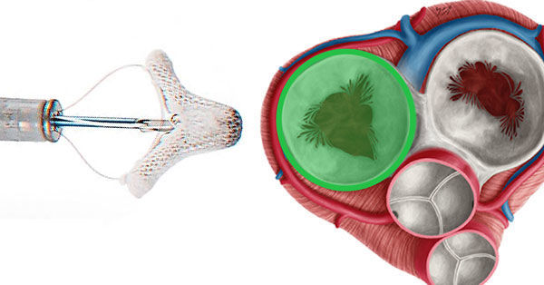 Tricuspid Valve Clinical Trials