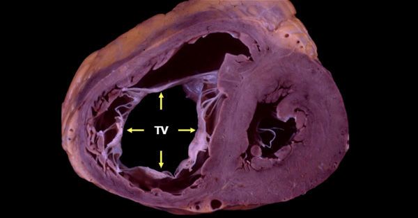 Tricuspid valve measurements in heart