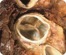 Tricuspid Stenosis