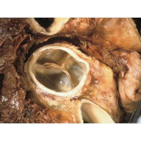 Normal Tricuspid Valve Picture