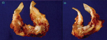 Unicuspid Aortic Heart Valve Extracted