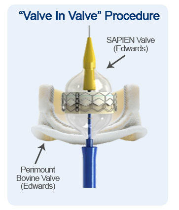 Valve In Valve Aortic Valve Procedure Diagram