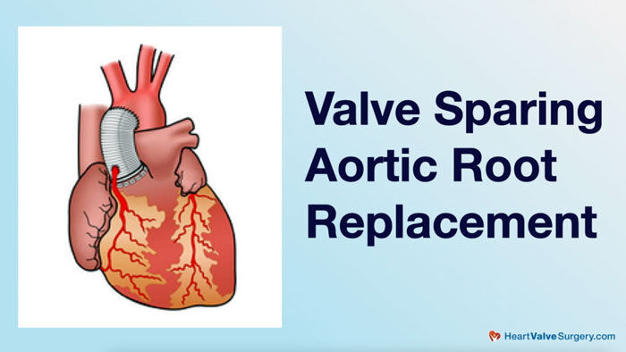 Valve Sparing Aortic Root Replacement