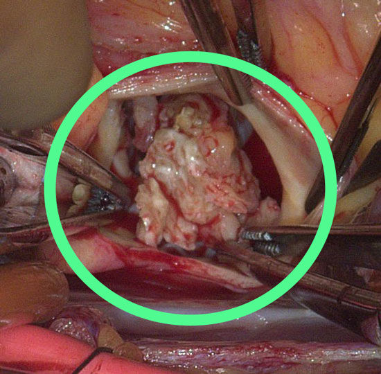 Bicuspid aortic valve with calcium deposits (aortic stenosis)