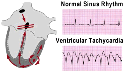 Ventricular Tachycardia After Heart Valve Surgery