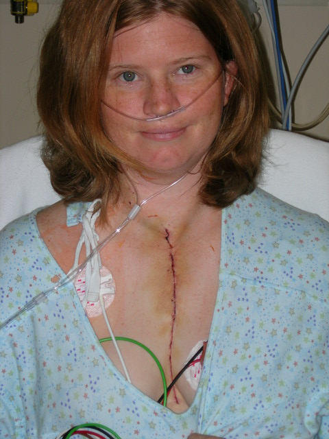 Woman With Heart Surgery Scar After Operation In The Hospital