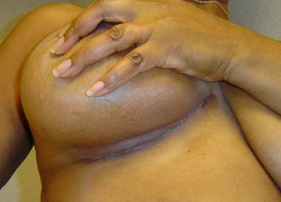 Women's scar under breast after minimally-invasive heart surgery
