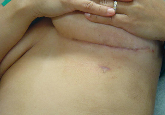 Female scar under breast after heart surgery
