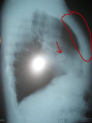 Xray Of Mechanical Heart Valve And Sternum Wires