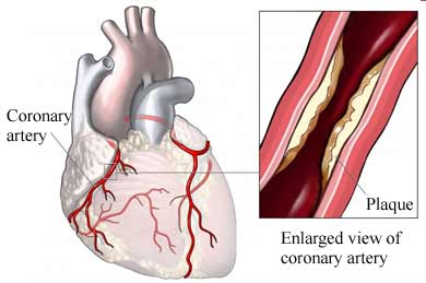 Coronary Artery Disease