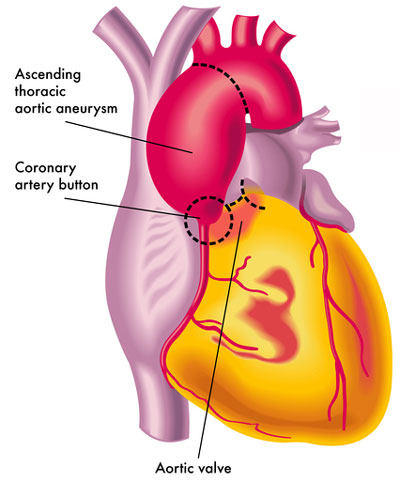 Aortic Aneursym Guidelines