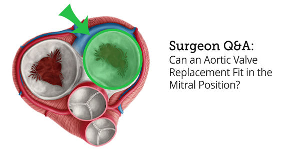 aortic-mitral-replacement-farivar