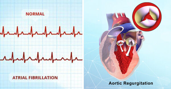 Aortic Valve Regurgitation and Atrial Fibrillation