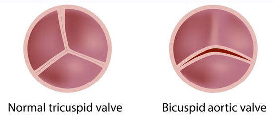 Normal and Bicuspid Bicuspid Aortic Valve