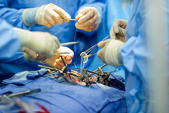 Annuloplasty Ring Being Prepared For Implant