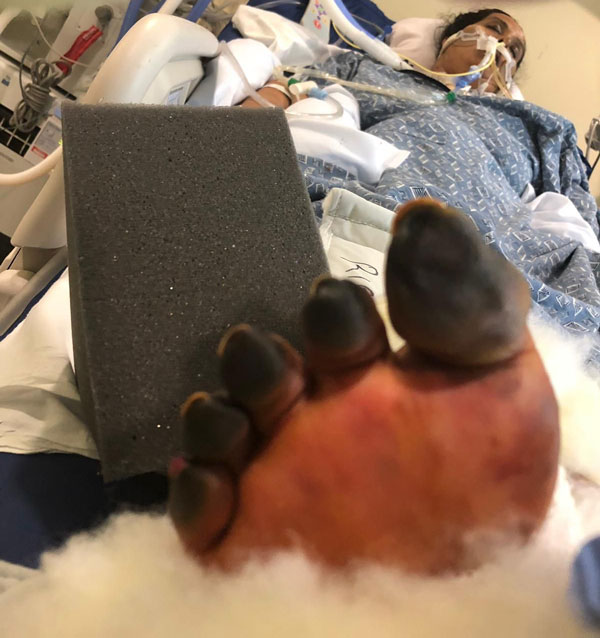 Padma Iyer Foot Before Amputation