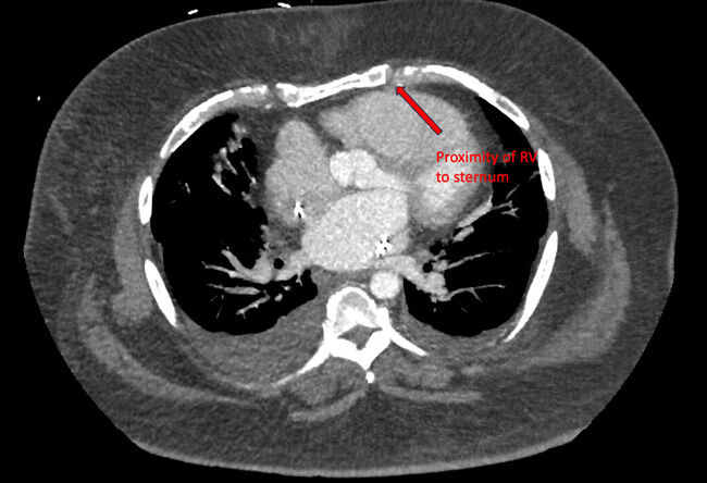 Proximity of Right Ventricle to Sternum