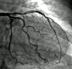 Angiogram Picture