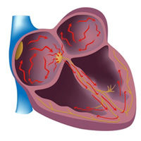 Atrial Fibrillation & Heart Valve Surgery
