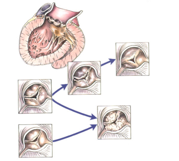 Aortic Valve Stenosis Progression