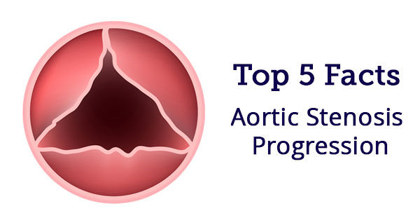 Facts About Aortic Stenosis