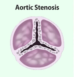 NAVITOR TAVR Valve Aortic Stenosis
