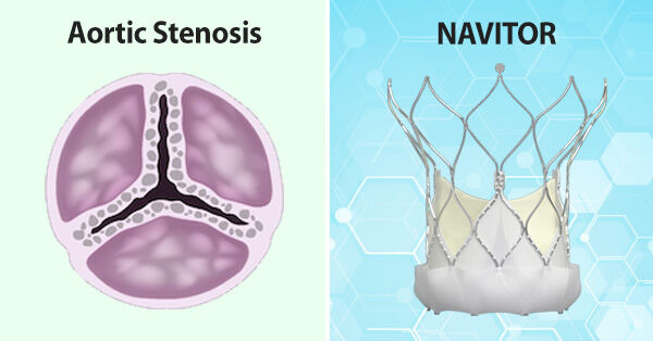 NAVITOR TAVR Valve Aortic Stenosis